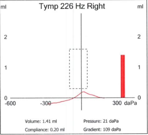 Tympanometry: What It Is and Types of .